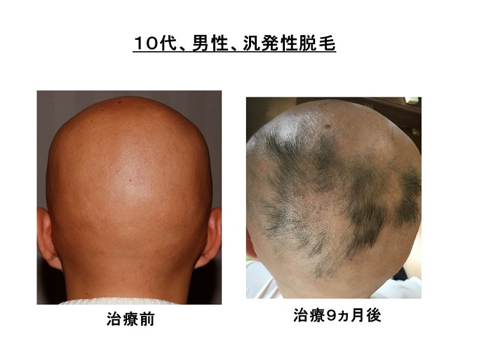 円形脱毛症　病院